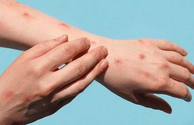 First Confirmed Case of Monkeypox Emerges in Islamabad