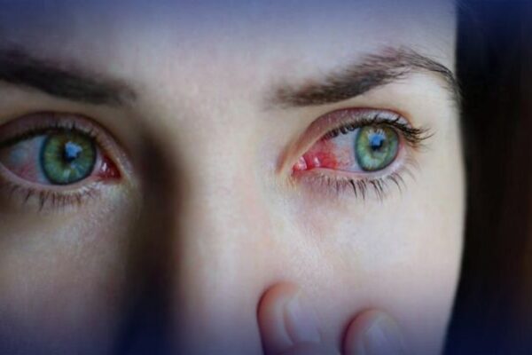 Khyber-Pakhtunkhwa reports surge in ‘pink eye’ cases
