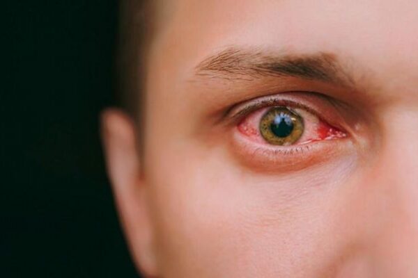 Twin cities hit by conjunctivitis surge