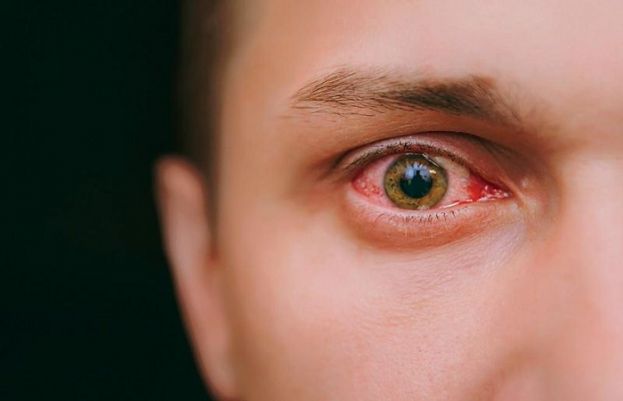 Twin cities hit by conjunctivitis surge